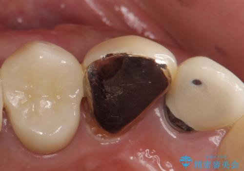 オールセラミッククラウン　歯と被せ物の隙間にできた虫歯の治療の症例 治療前