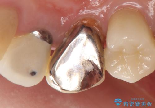 オールセラミッククラウン　歯と被せ物の隙間にできた虫歯の治療の治療前