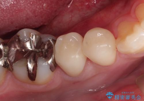 虫歯の治療　適合の良いセラミッククラウンの症例 治療後