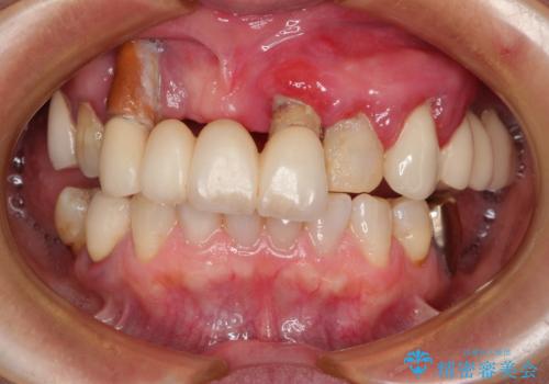 前歯が抜け落ちそう　インプラントと入れ歯を用いた全顎治療の症例 治療前