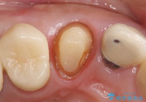 オールセラミッククラウン　歯と被せ物の隙間にできた虫歯の治療の治療中