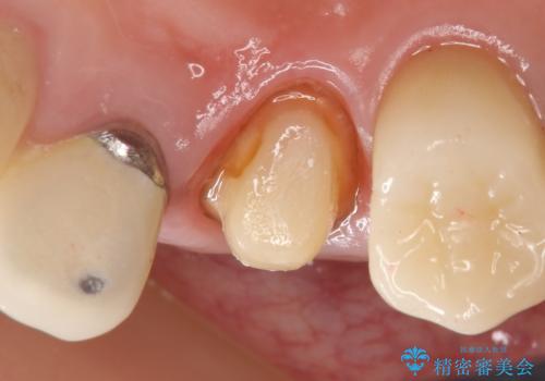 オールセラミッククラウン　歯と被せ物の隙間にできた虫歯の治療の治療中