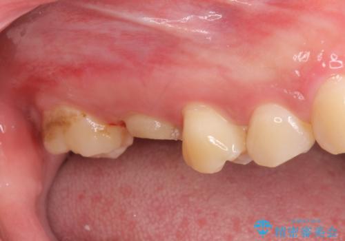 オールセラミッククラウン　歯茎より深い虫歯(縁下カリエス)の治療の治療前