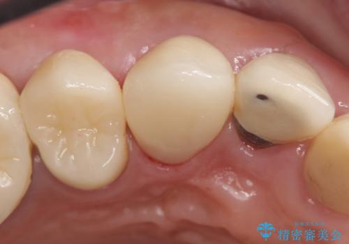 オールセラミッククラウン　歯と被せ物の隙間にできた虫歯の治療