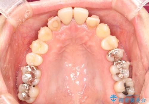 出っ歯が気になる　オープンバイトを伴う前突症のインビザライン治療・セラミック治療　invisalignの治療中