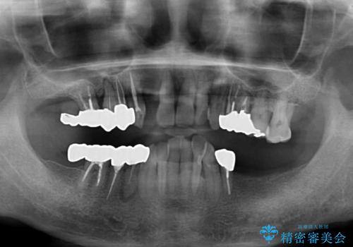 ボロボロの歯を何とかしたい　総合歯科治療による全顎治療の治療前