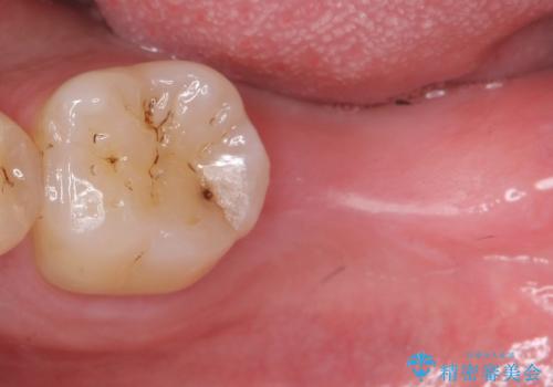 [30代男性] インプラント　失った歯の治療の症例 治療前