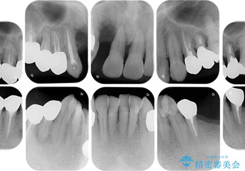 ボロボロの歯を何とかしたい　総合歯科治療による全顎治療の治療前