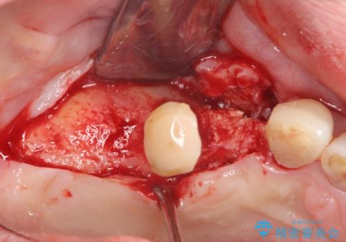 重度に吸収した歯槽骨を再建　インプラント咬合機能回復の治療中