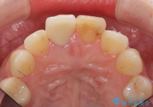 前歯の変色　見える前歯の審美改善セラミック治療の治療後