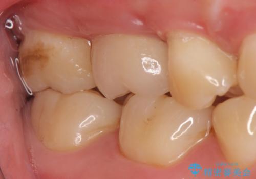 オールセラミッククラウン　歯茎より深い虫歯(縁下カリエス)の治療の治療後