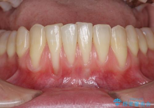 [歯茎の再生]  歯肉移植3年経過後の状態の治療前