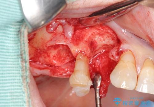 重度に吸収した歯槽骨を再建　インプラント咬合機能回復の治療中