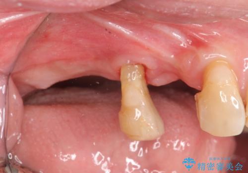 重度に吸収した歯槽骨を再建　インプラント咬合機能回復の治療前