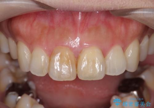 前歯の変色　見える前歯の審美改善セラミック治療の治療前