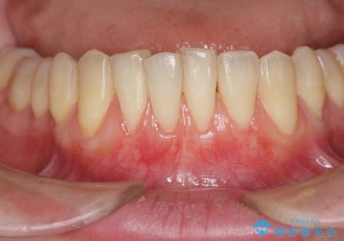 [歯茎の再生]  歯肉移植3年経過後の状態の治療中