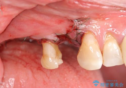 重度に吸収した歯槽骨を再建　インプラント咬合機能回復の症例 治療後