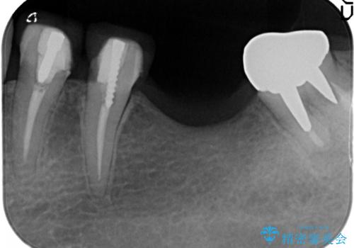 骨が薄い部位への骨造成をともなうインプラントの治療前