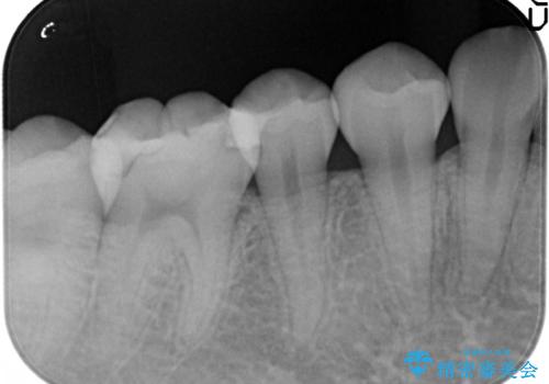 自然な見た目のセラミックインレーの治療後