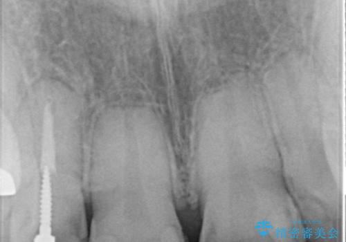 前歯のつめものが汚い セラミックできれいにの治療前