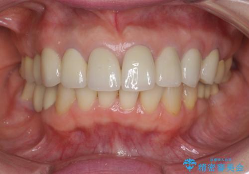 前歯の突き上げを改善する　インビザライン による小矯正の治療後