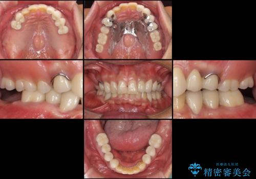 奥歯で物を噛めるようにしたい 入れ歯による咬合回復の治療後