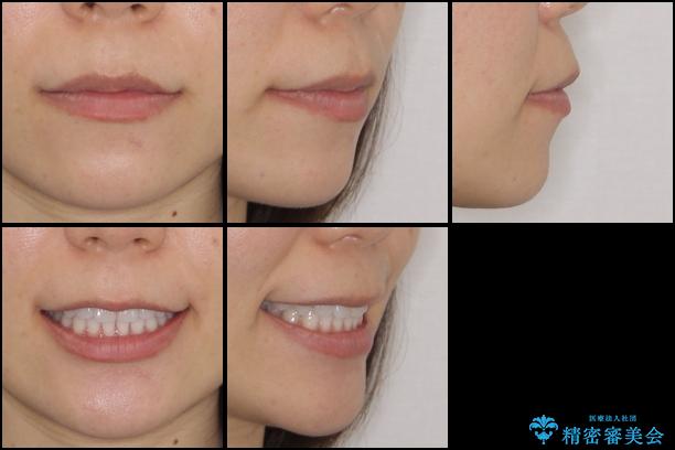 反対咬合を治したい インビザラインによる矯正治療の治療後(顔貌)