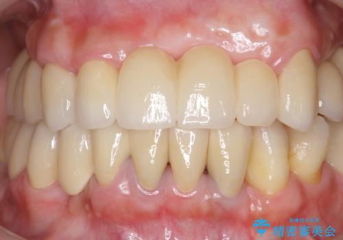 歯周病 全顎治療の治療後
