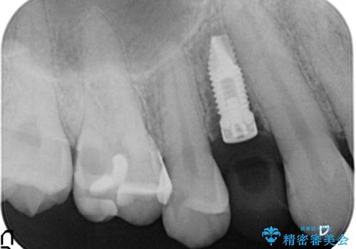 インプラントによる咬合回復の治療中
