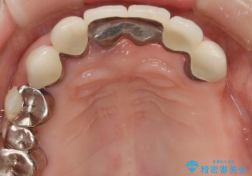 歯周病 全顎治療の治療前