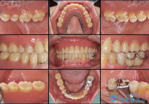 インプラントと入れ歯による全顎補綴治療の治療後