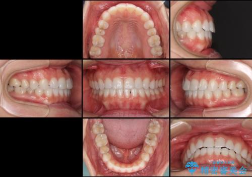 反対咬合を治したい インビザラインによる矯正治療の治療後