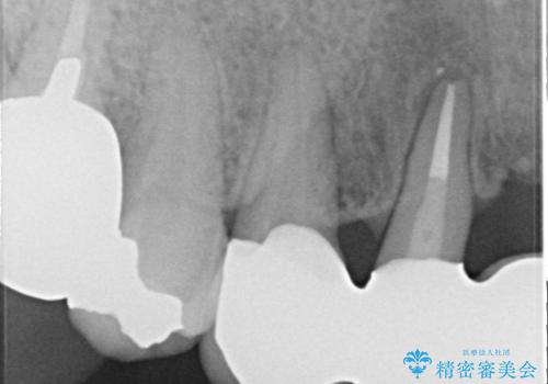 矯正を併用した前歯のセラミックブリッジ治療の治療後