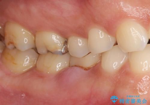 残せなくなってしまった乳歯 インプラントによる補綴の治療前