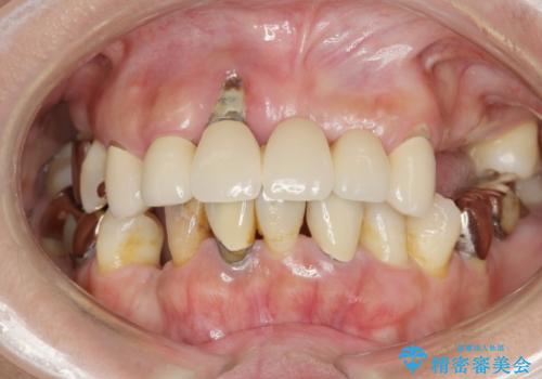 歯周病 全顎治療の症例 治療前