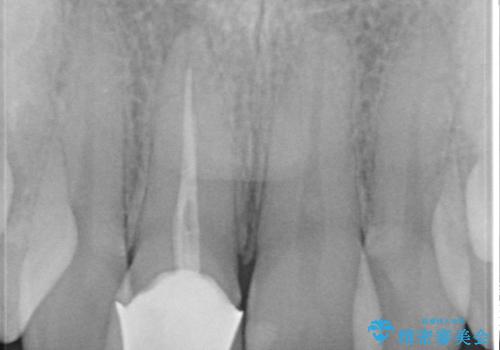 前歯の治療。再根管治療~セラミッククラウンの症例 治療前
