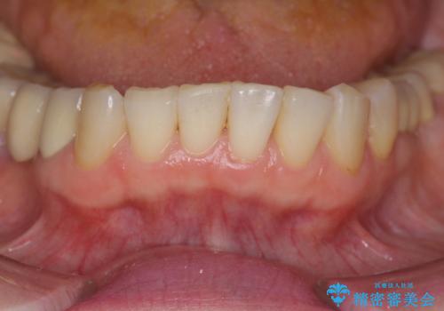 前歯の突き上げを改善する　インビザライン による小矯正の症例 治療後