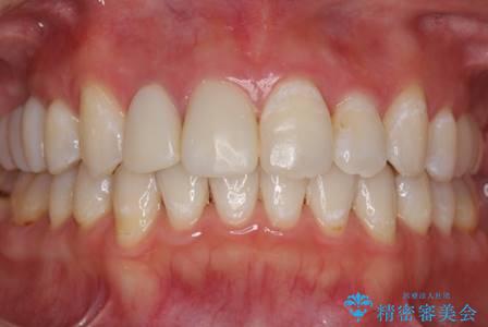歯を透明感のある白さに。の症例 治療後