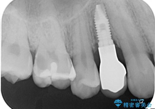 インプラントによる咬合回復の症例 治療後