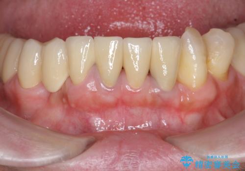 歯周病 全顎治療の治療後