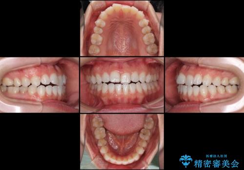 反対咬合を治したい インビザラインによる矯正治療の治療中