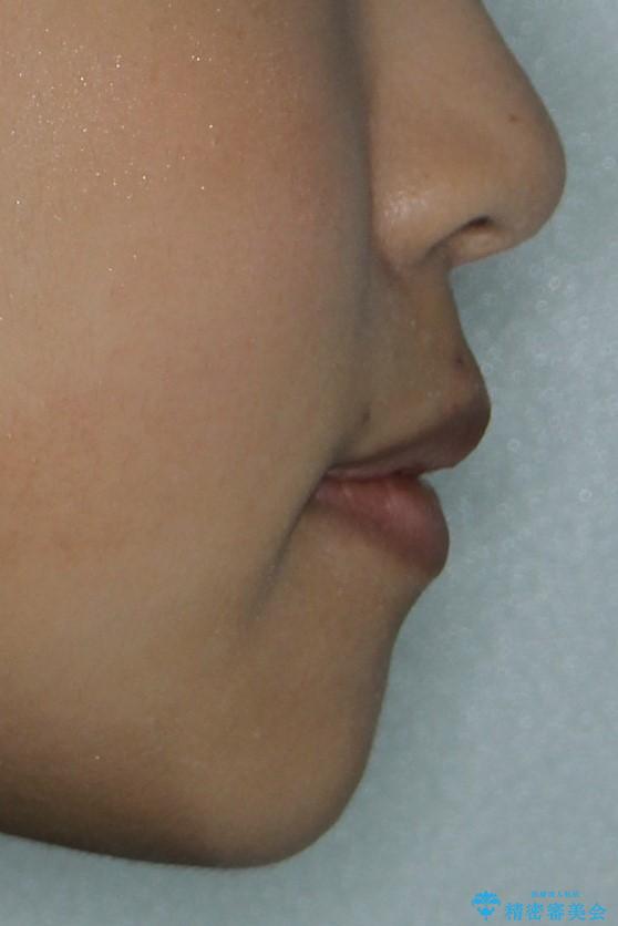 ハーフリンガル 半分裏側矯正による上下前突の抜歯矯正治療の治療後(顔貌)