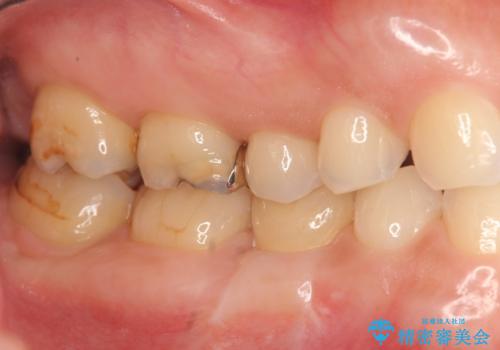 残せなくなってしまった乳歯 インプラントによる補綴の治療後