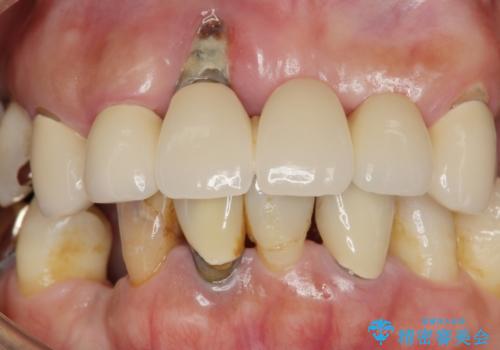 歯周病 全顎治療の治療前