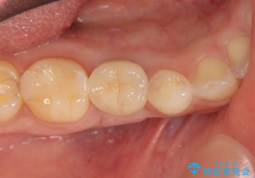 残せなくなってしまった乳歯 インプラントによる補綴の治療後