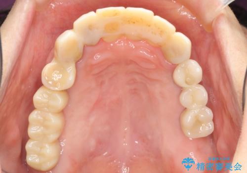 歯周病 全顎治療の治療中