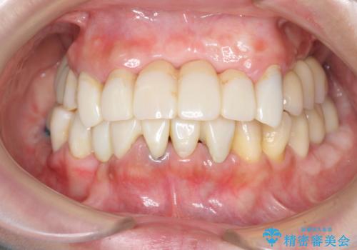 歯周病 全顎治療の治療中