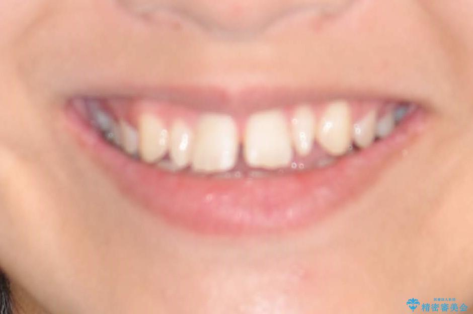 歯の形態修正も含めた矯正治療&セラミック治療の治療前(顔貌)