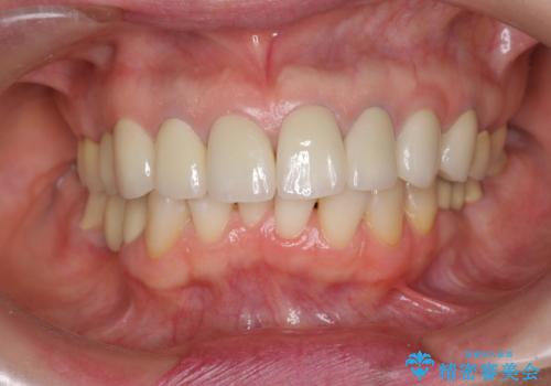 前歯の突き上げを改善する インビザライン による小矯正の治療前