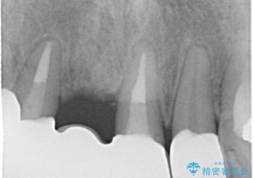 矯正を併用した前歯のセラミックブリッジ治療の治療後